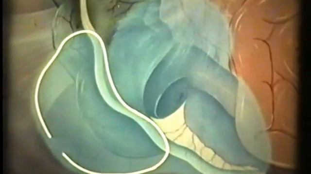 Аппендэктомия, острый аппендицит, академик В.В.Кованов © Appendectomy смотреть онлайн