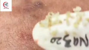 enjoy your day with hana beauty #4 #acne removal #blackhead