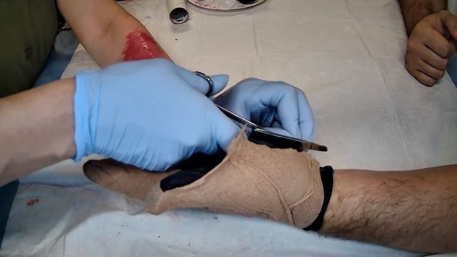 Trauma- Avulsion: Degloving смотреть онлайн