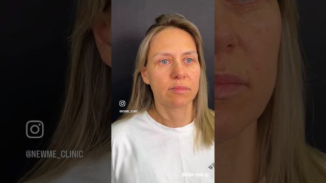 Пластика верхних и нижних век  #блефаропластика  #пластикавек