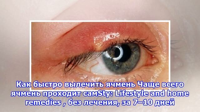 Что делать, если на глазу вскочил ячмень смотреть онлайн