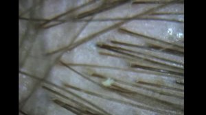 Кожа головы. Закупорка пор. Рост волос.