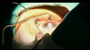 Замена хрусталика глаза