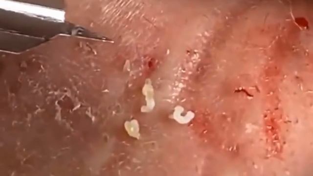 Satisfying Blackhead Extraction Cystic Acne & Pimple Popping #2