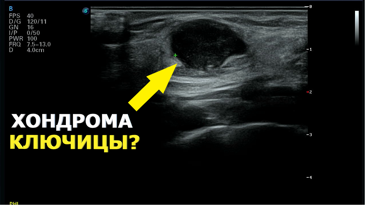Образования ключицы на УЗИ