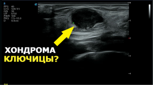 Образования ключицы на УЗИ