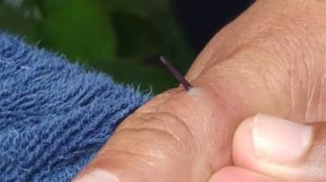 Заноза. Как вытащить занозу.