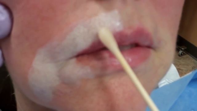 Phenol Croton Oil Peel - Pacific Heights Plastic Surgery смотреть онлайн
