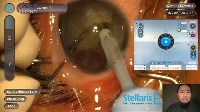 FEEL THE DIFFRENT OF SEAMLESS PHACO WITH NO WORRIES BY RIO RHENDY, MD смотреть онлайн