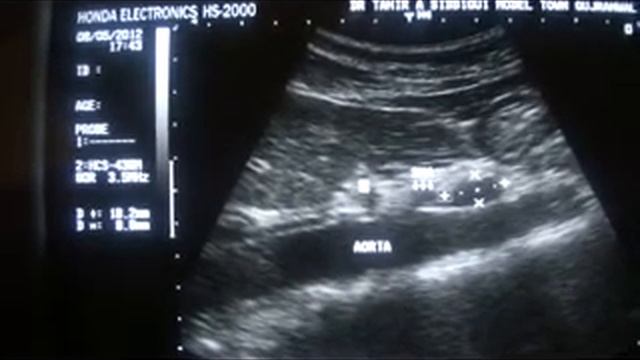 SOLITARY PARA-AORTIC PLAIN ENLARGED LYMPH NODE смотреть онлайн