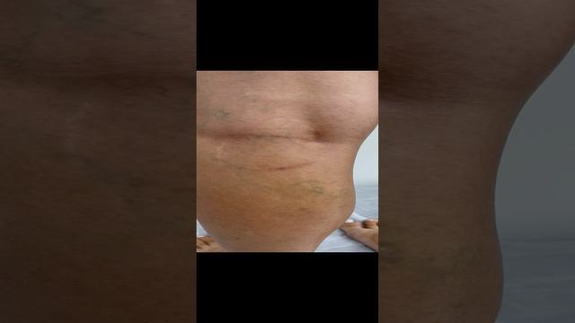 Ретикулярный варикоз. Сосудистая сетка. Готовимся к склеро. Узи сосудов. Флеболог Москва. Флеболог смотреть онлайн