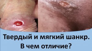 Твердый и мягкий шанкр. В чем отличие?