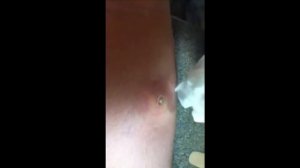 БОЛЬШОЙ ГНОЙНИК