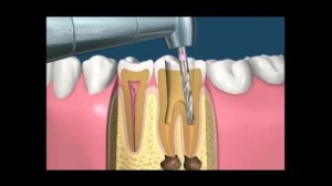 Обработка корневых каналов и пломбирование гуттаперчей