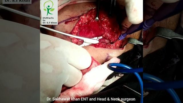 SUBMANDIBULAR SALIVARY GLAND EXCISION, SUBMANDIBULAR SALIVARY GLAND BIOPSY, SALIVARY GLANDS смотреть онлайн
