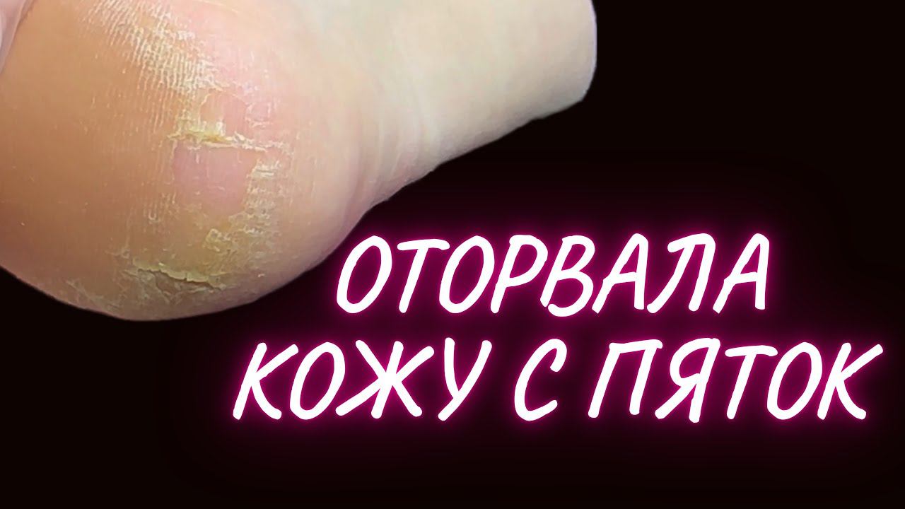ОНА ОТОРВАЛА КОЖУ С ПЯТОК | ПЕДИКЮР | ПЕДИКЮР С ГЛУБОКИМИ ТРЕЩИНАМИ смотреть онлайн