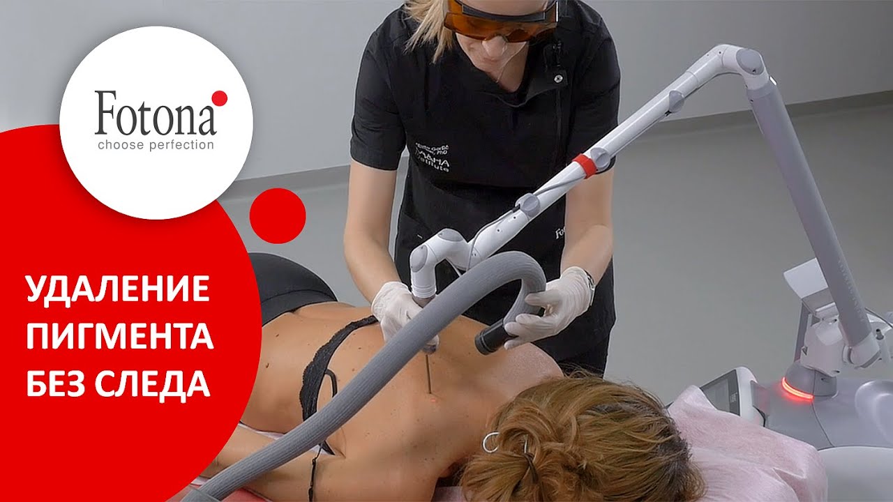 Лазерное удаление пигментации без следа. Стойкий эффект надолго! смотреть онлайн