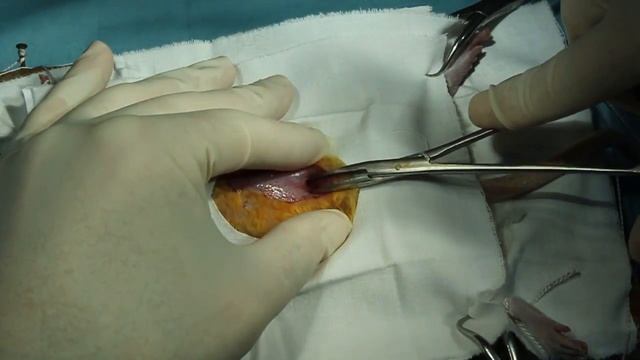 Разъединение мышц тупым способом смотреть онлайн