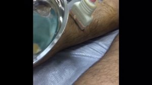 Пункция кисты Беккера  под контролем УЗИ (Becker cyst puncture under ultrasound)