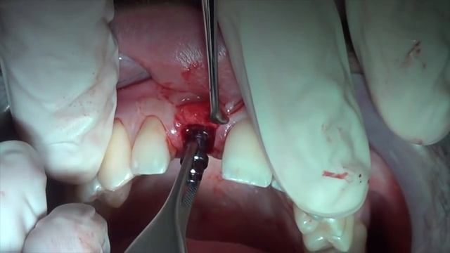 Roll Technique With Implant Placement