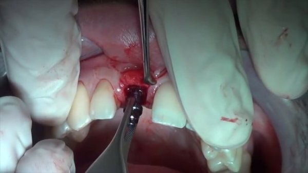 Roll Technique with implant placement