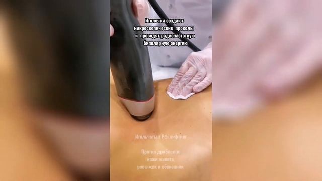 Фракционный игольчатый рф лифтинг зоны живота аппарат Infini смотреть онлайн