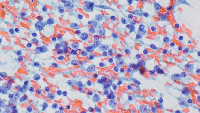 Cervical Lymph Node FNA: Metastatic Nasopharyngeal Carcinoma смотреть онлайн