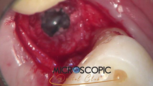 Crestal approach sinus lift with simultaneous implant position смотреть онлайн