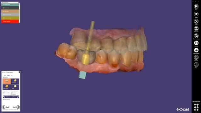 NEW: exocad ChairsideCAD 2.3 Matera смотреть онлайн