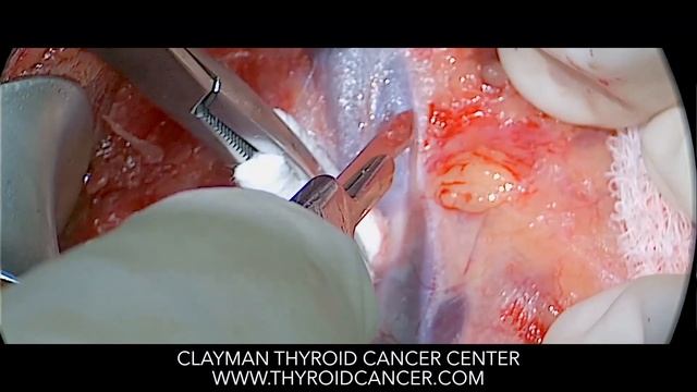 Right Neck Dissection for Thyroid Cancer смотреть онлайн