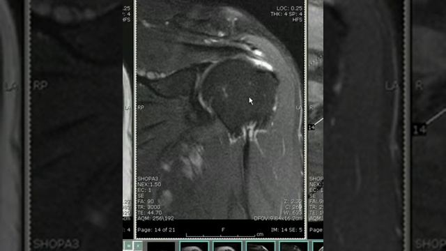 Musculoskeletal MR - Shoulder смотреть онлайн