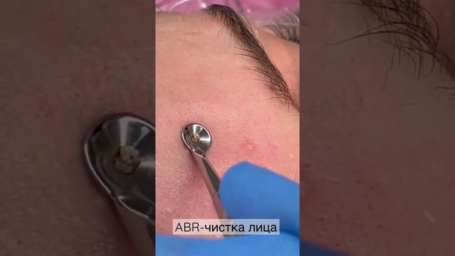 ABR-чистка лица смотреть онлайн