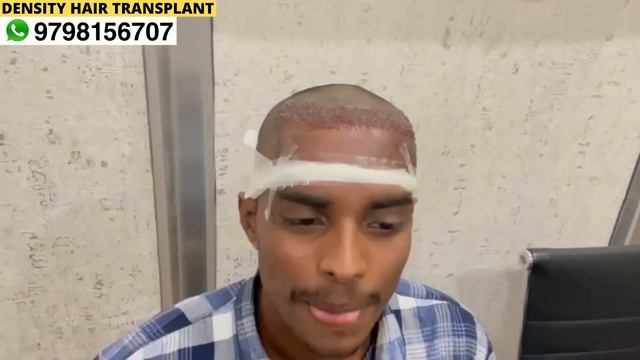 FUE Hair Transplant Results, Hair Transplant Before And After | Dr. Santosh Modi смотреть онлайн