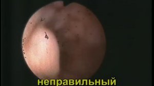 Атипическая гиперплазия эндометрия. Гистероскопия.