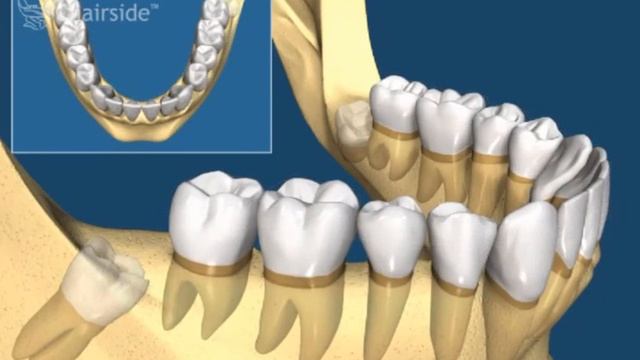 скученность зубов от зуба мудрости смотреть онлайн
