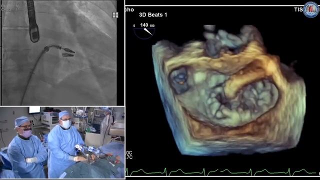 MitraClip™: a step by step guide for surgeons смотреть онлайн