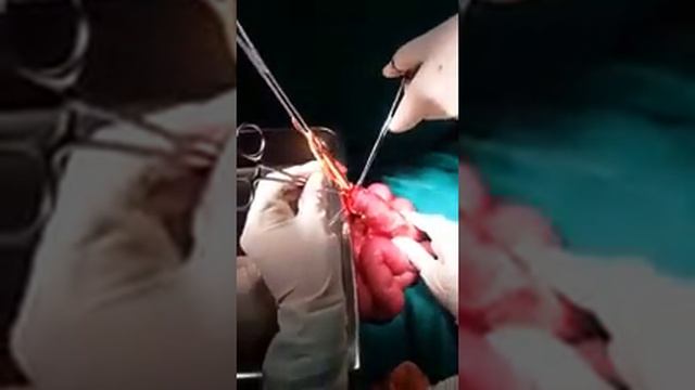 Удаление паразитов у человека