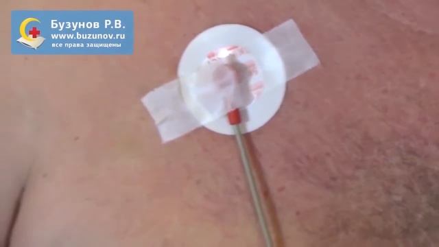 Как проводится полисомнография для диагностики обструктивного апноэ сна. Постановка датчиков смотреть онлайн