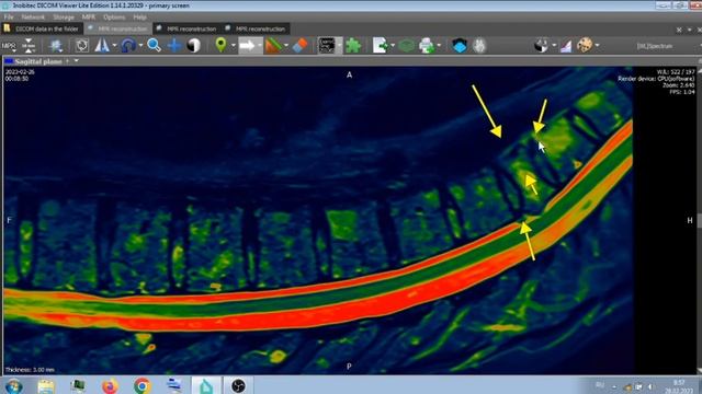 КОМПРЕССИОННЫЕ ПЕРЕЛОМЫ НА МРТ .
