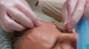 Мезонити. Лифтинг верхнего века.