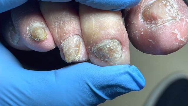 Very Hard Onychomycosis, Infected Every Toe【Pedicure Master Lin Jun】