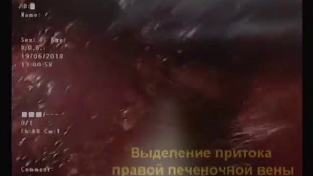 Лапароскопическая резекция 7 сегмента печени с использованием водоструйного диссектора. смотреть онлайн