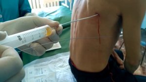 Thoracentesis to remove Pleural Fluid.  Плевральная пункция и дренирование.