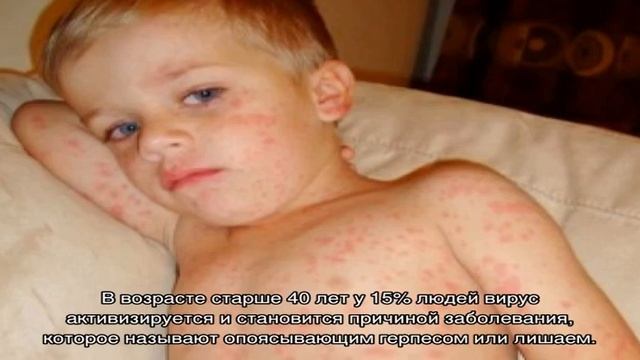 Можно ли заболеть ветрянкой второй раз? смотреть онлайн