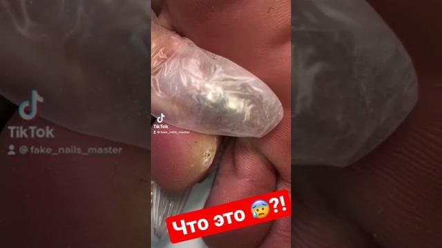 Нарост на ноге. НАТОПТЫШ.бородавка.стержневая мозоль. Педикюр. Сухие пятки.core corn. Deep callus смотреть онлайн