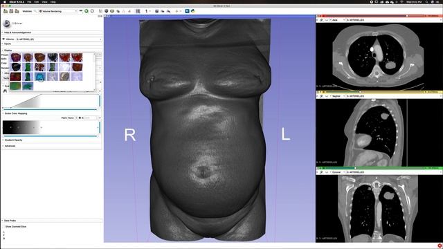 3D Slicer - Volume Rendering and Crop Volume смотреть онлайн