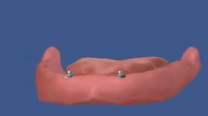 условно съемный протез с шариками на 2 имплантах - Protezist