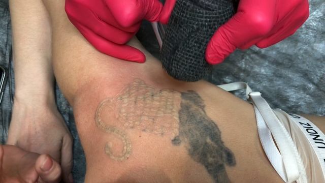 Настоящее безопасное удаление тату лазером В СПб смотреть онлайн