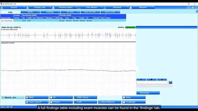 Keypoint.Net v2.40 – using the EMG findings table смотреть онлайн
