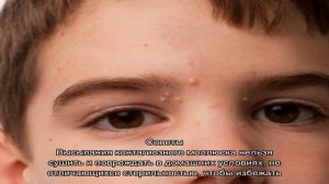 Доктор Комаровский о лечении детей, больных контагиозным моллюском